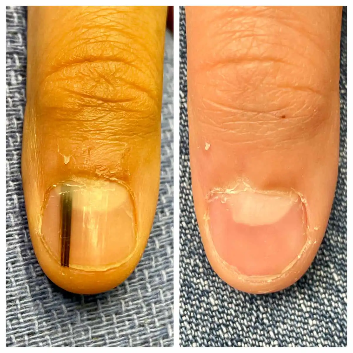 Longitudinal melanonychia nail before and after biopsy — St. Louis Dermatology & Cosmetic Surgery