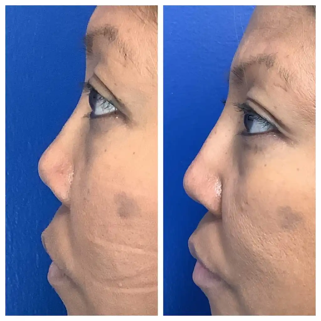 Non-surgical rhinoplasty before and after, profile view — St. Louis Dermatology & Cosmetic Surgery