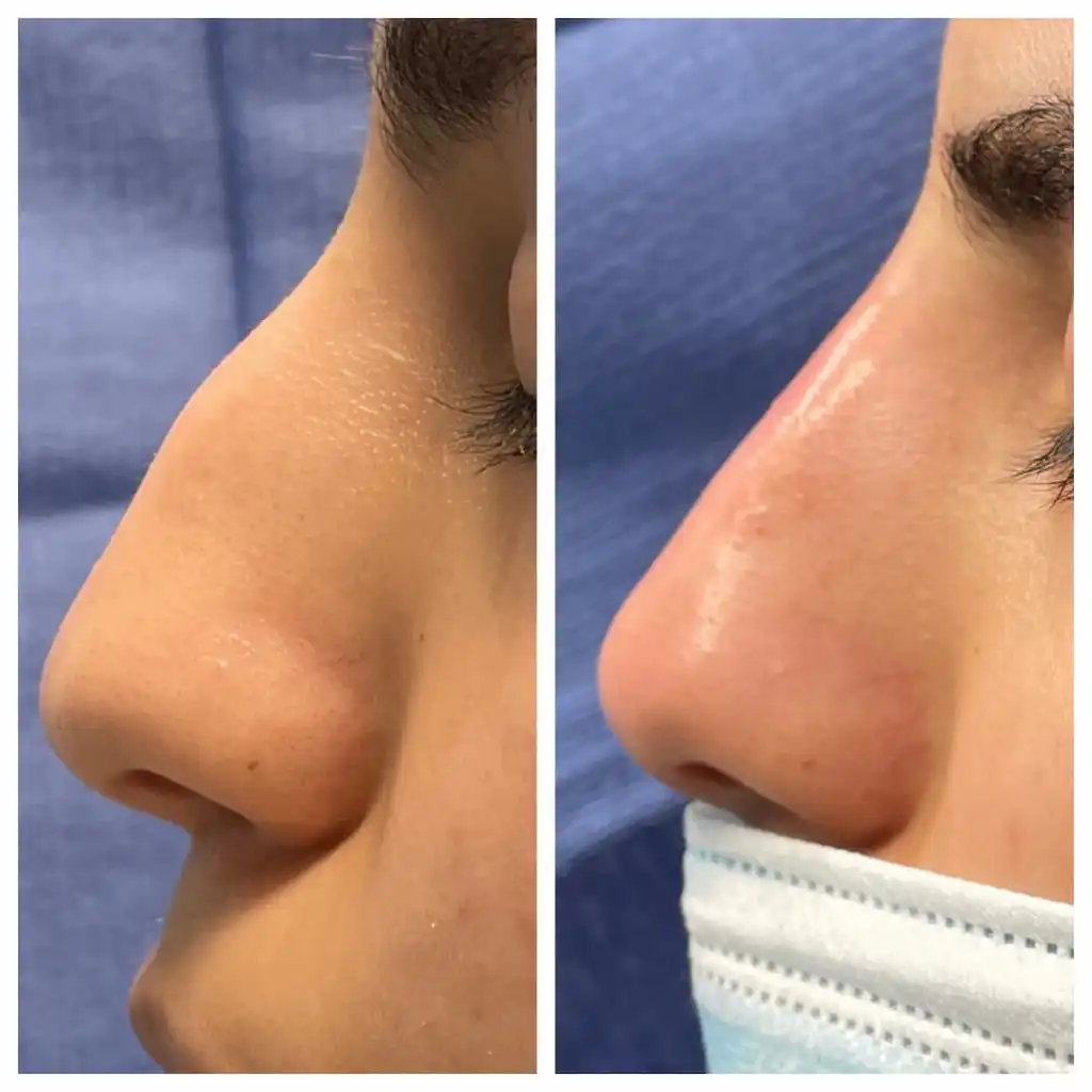 Non-surgical rhinoplasty before and after, close-up of the nose — St. Louis Dermatology & Cosmetic Surgery