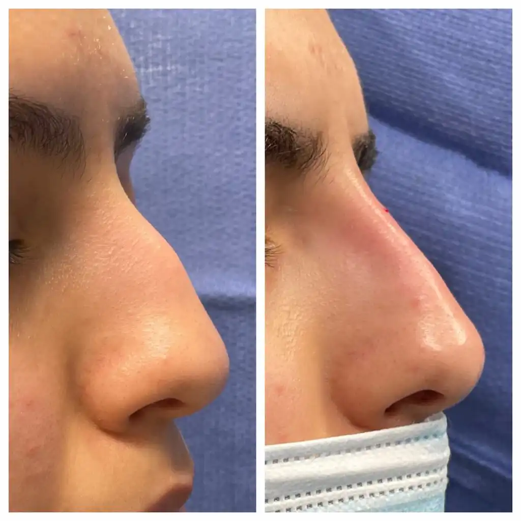 Non-surgical rhinoplasty before and after, close-up of the nose — St. Louis Dermatology & Cosmetic Surgery