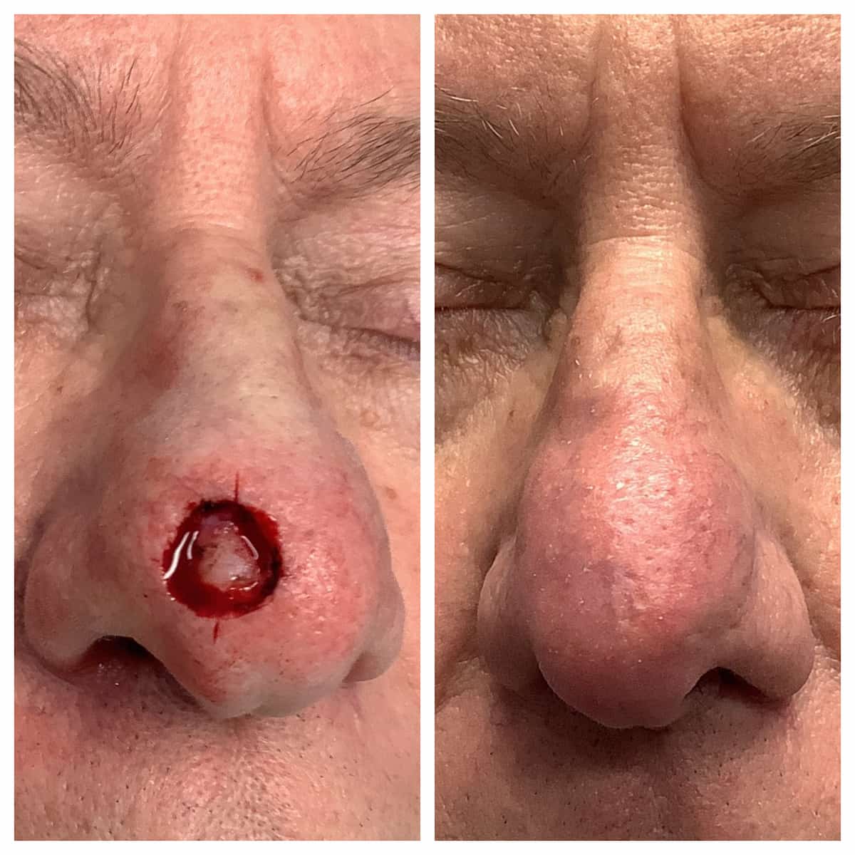 Nose Mohs surgery and reconstruction, before and after — St. Louis Dermatology & Cosmetic Surgery
