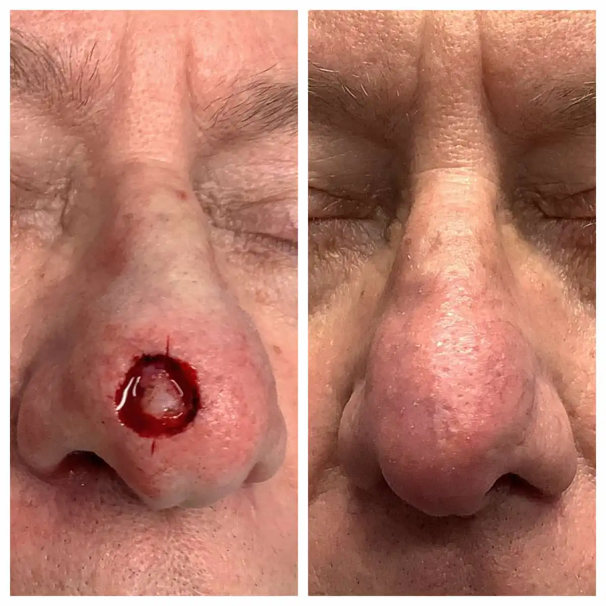 Nose Mohs surgery and reconstruction, before and after — St. Louis Dermatology & Cosmetic Surgery