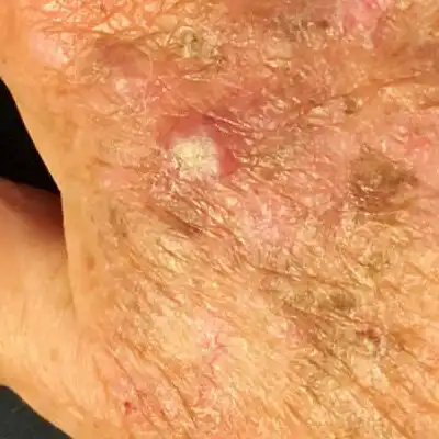squamous-cell-th