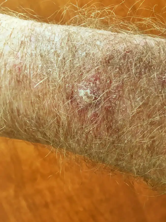 squamous1