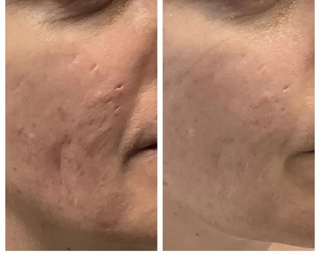 Acne scar treatment before and after on the cheek, patient of Dr. Brandon T. Beal