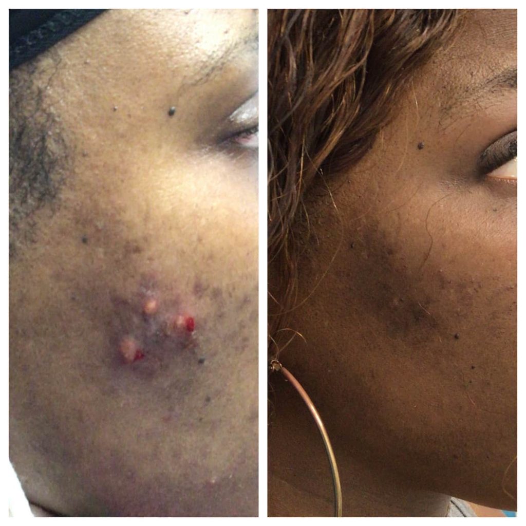 Acne before _ after
