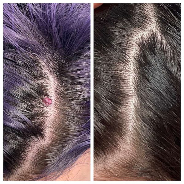 Cherry Angioma Before and After St. Louis Cherry Angioma Treatment