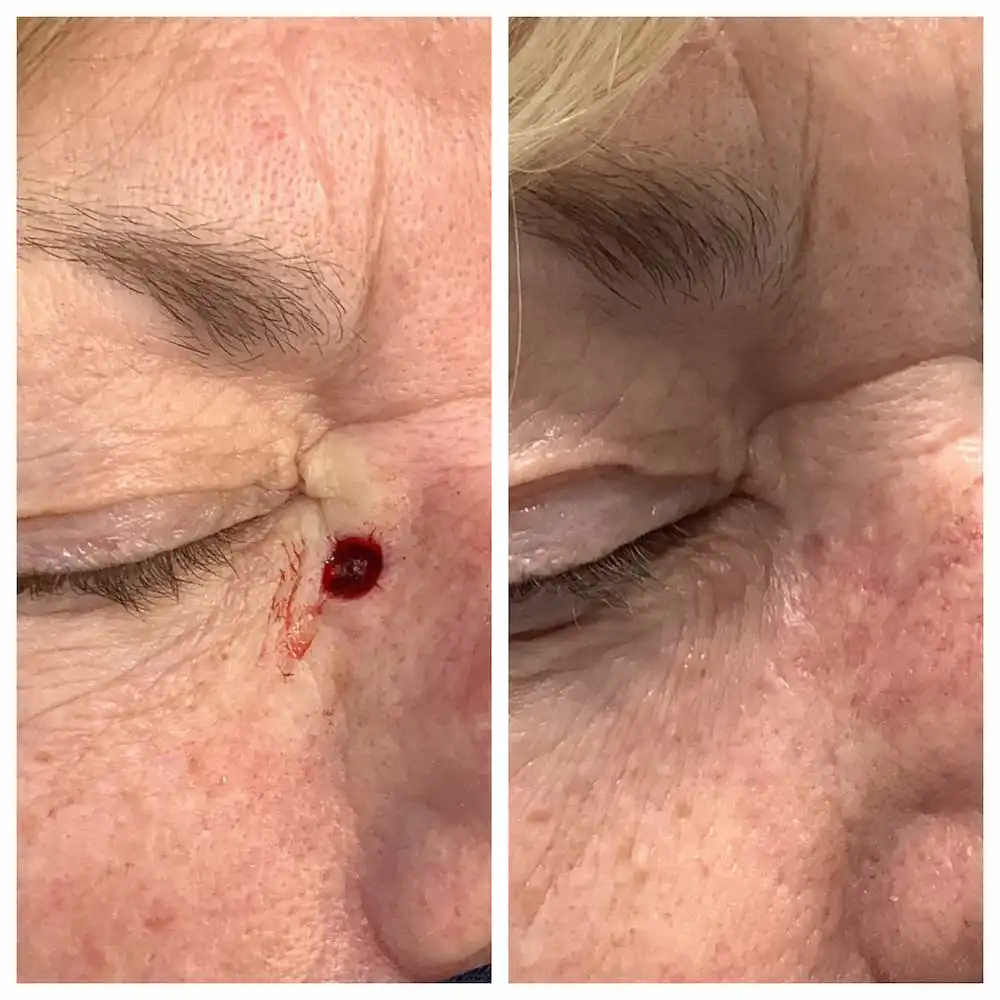 Eyelid Reconstruction 1