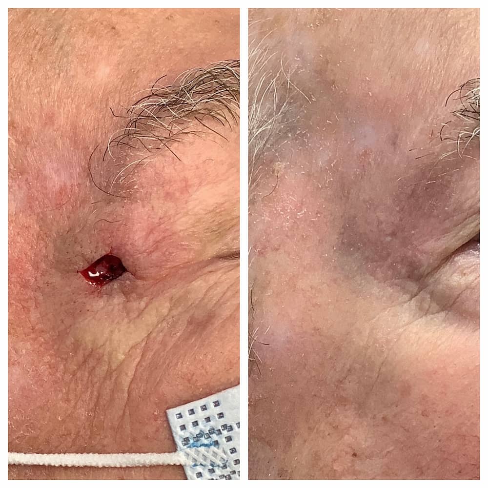 Eyelid Reconstruction after mohs surgery