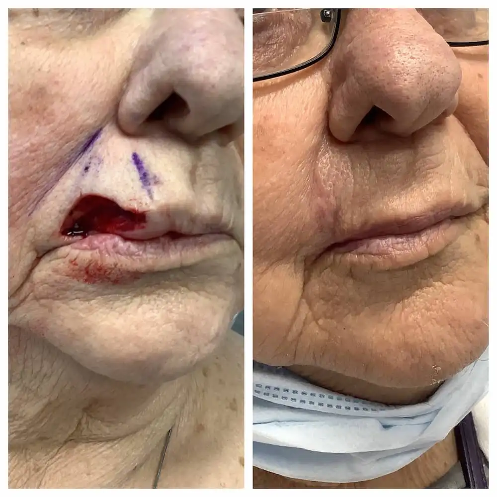 Lip Reconstruction 11