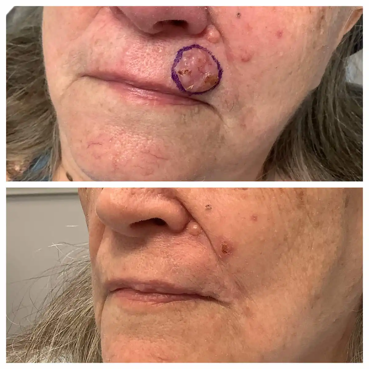 Basal cell carcinoma before, plastic reconstructive surgery after — St. Louis Dermatology & Cosmetic Surgery