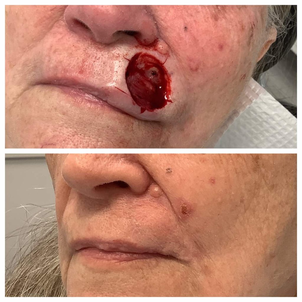 Lip Reconstruction before and after