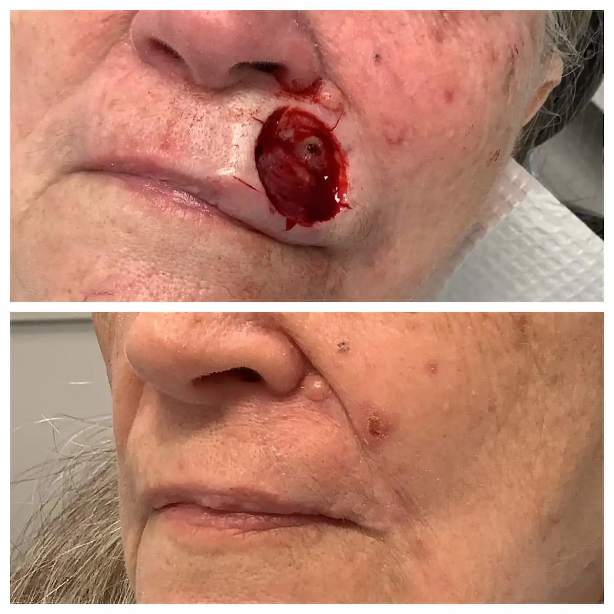 Mohs surgery before, plastic reconstructive surgery after — St. Louis Dermatology & Cosmetic Surgery