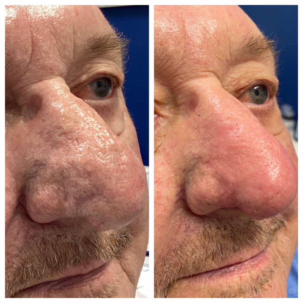 Rhinophyma Before and After