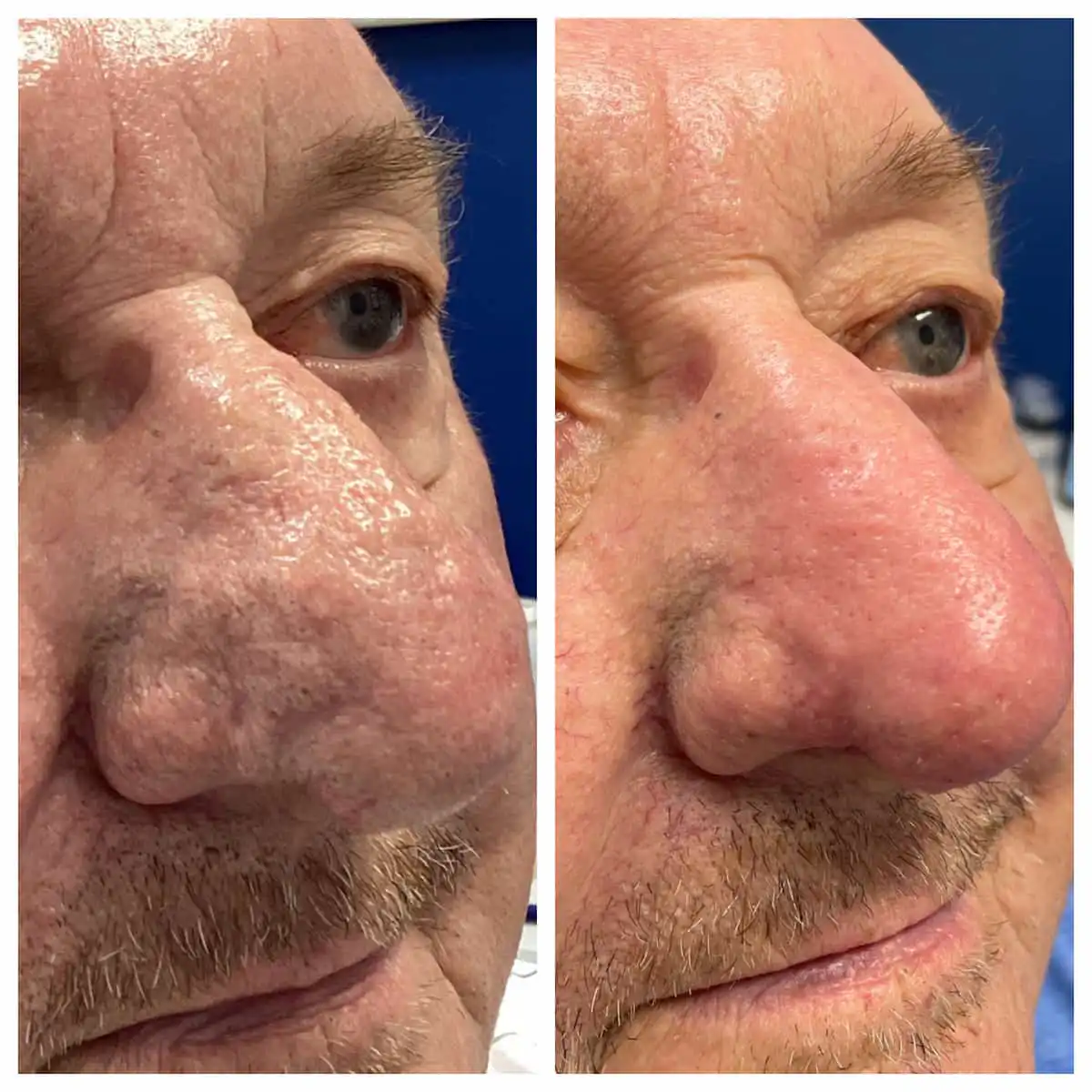 Rhinophyma surgical recontouring of the nose, before and after — St. Louis Dermatology & Cosmetic Surgery