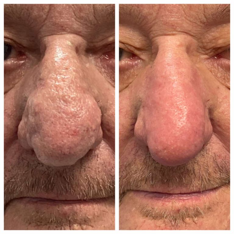 what-is-rhinophyma