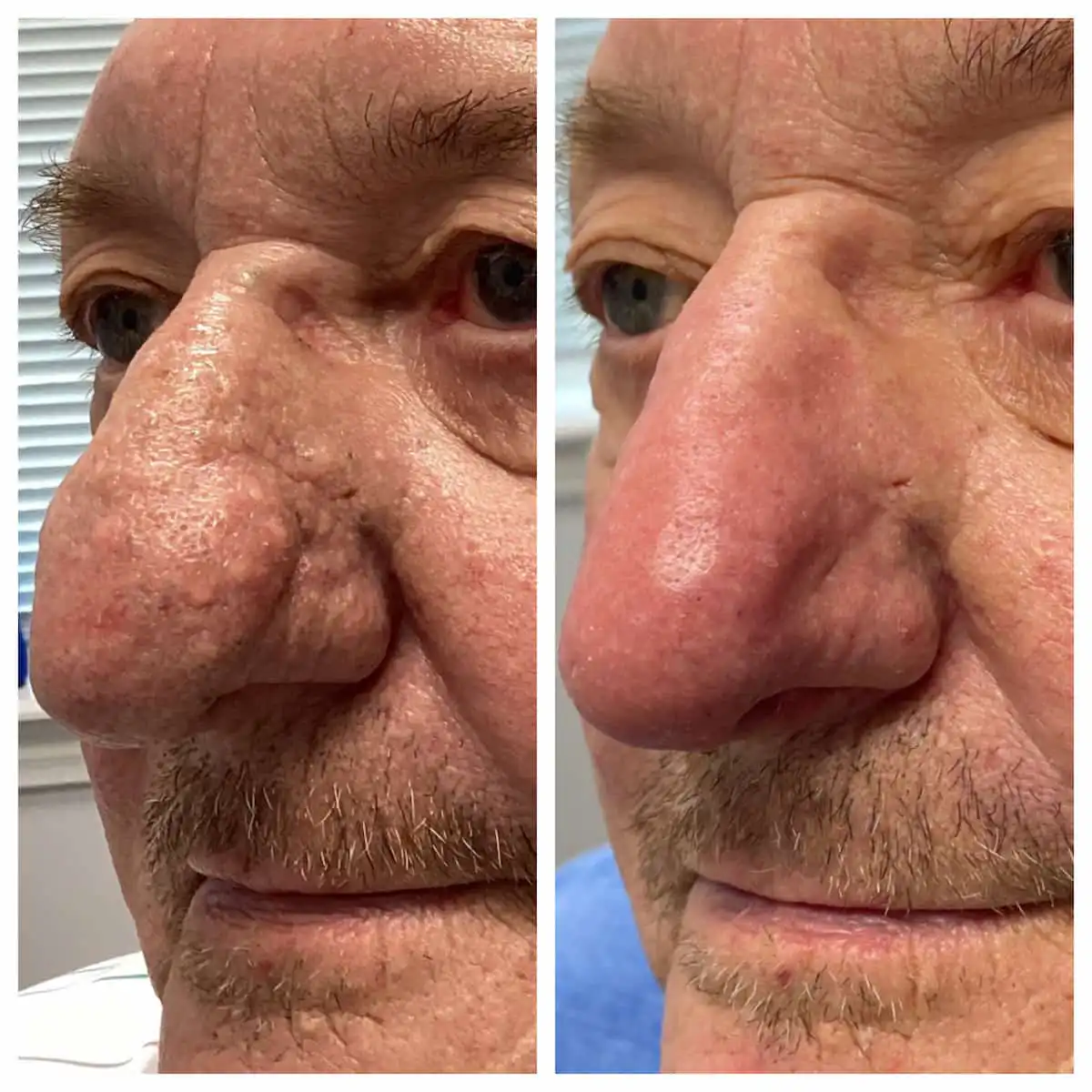 Rhinophyma surgical recontouring of the nose, before and after, side view — St. Louis Dermatology & Cosmetic Surgery