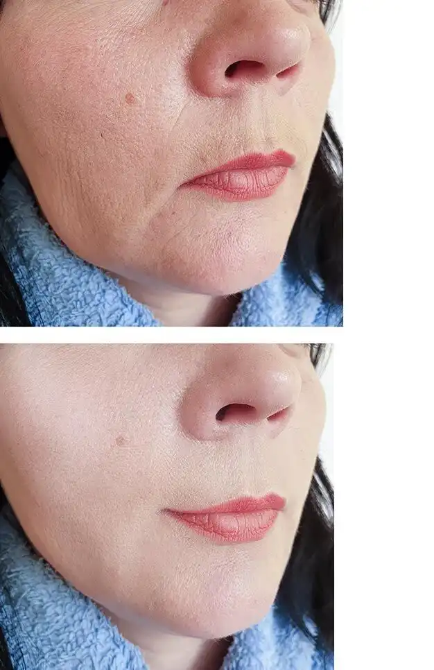 Cheek filler before and after softening the lower face, patient of Dr. Brandon T. Beal