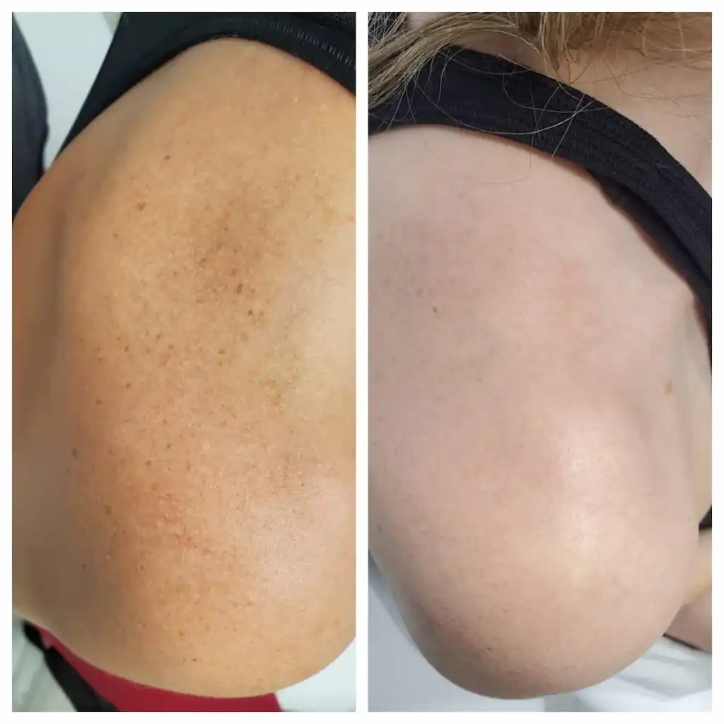chemical-peel-cost
