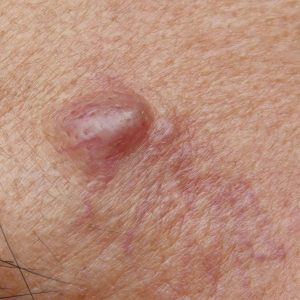 cyst-removal-st-louis