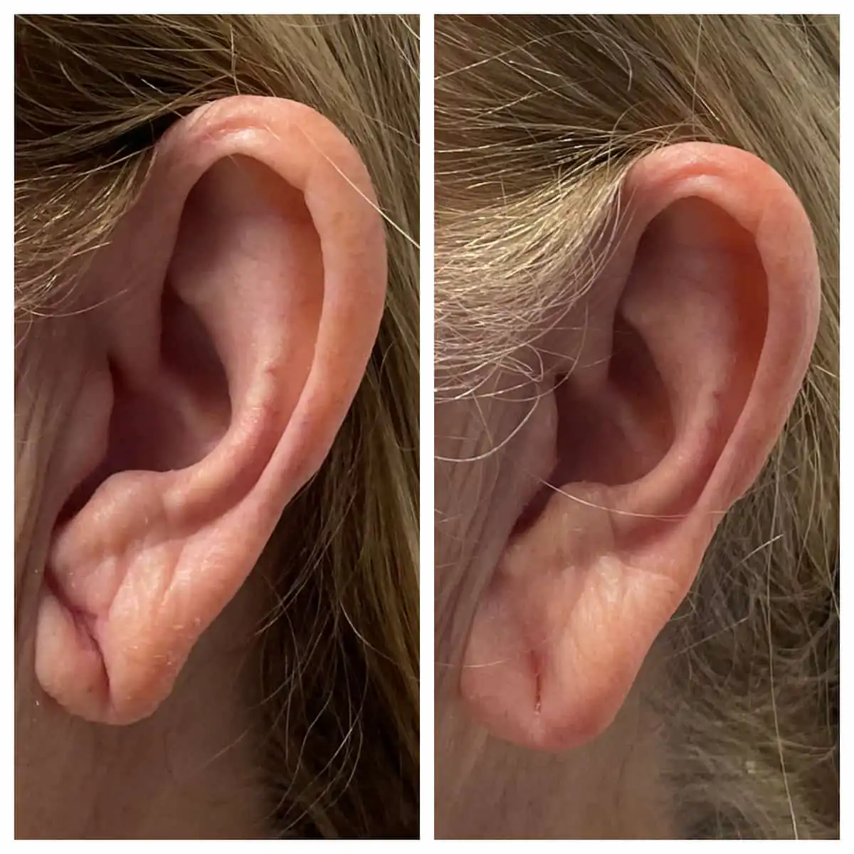 Earlobe filler before and after restoring volume, patient of Dr. Brandon T. Beal