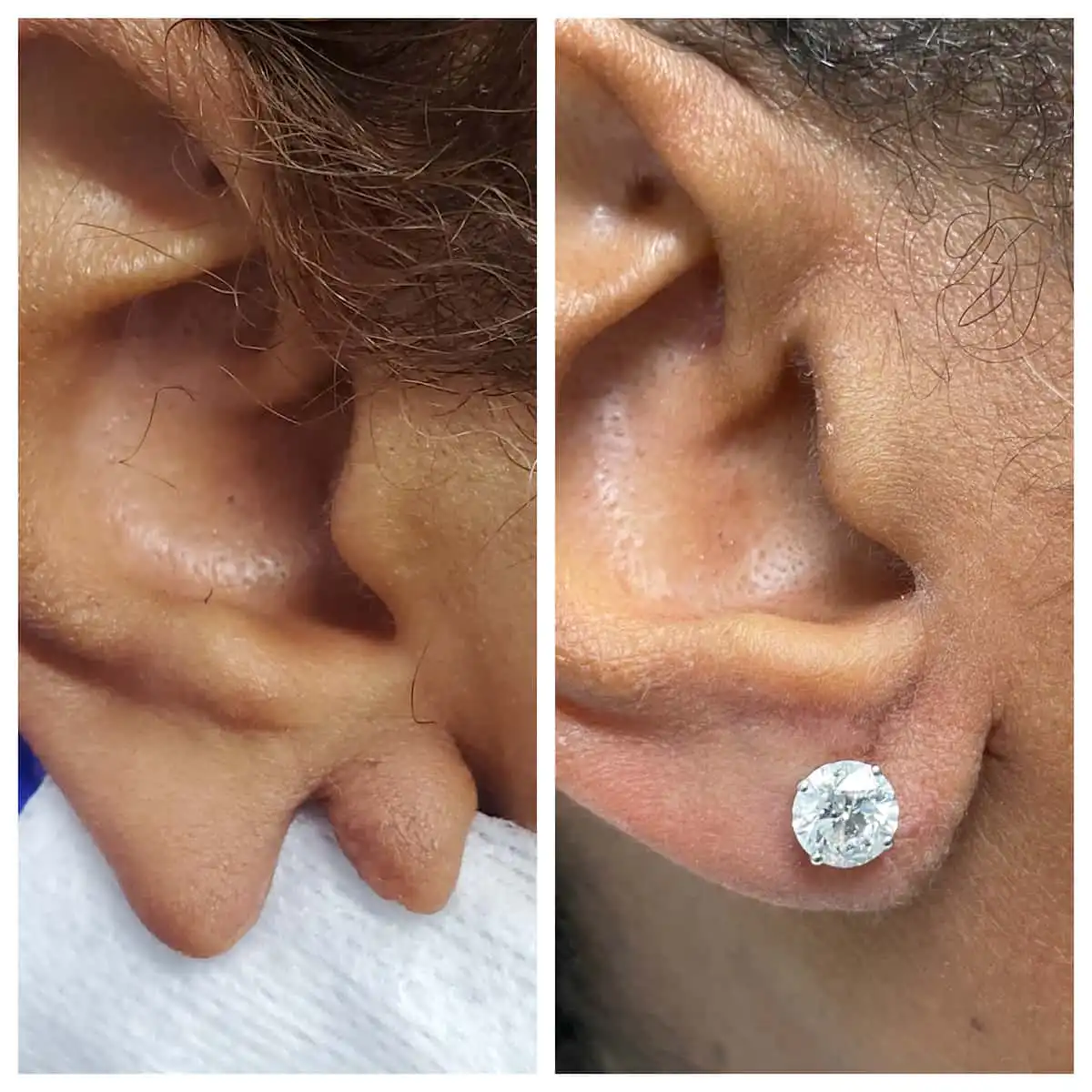 Earlobe repair before and after — St. Louis Dermatology & Cosmetic Surgery