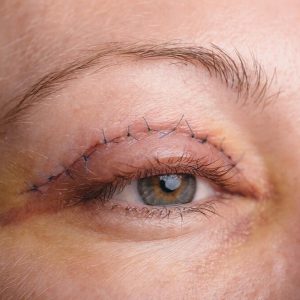 eyelid-surgery-after