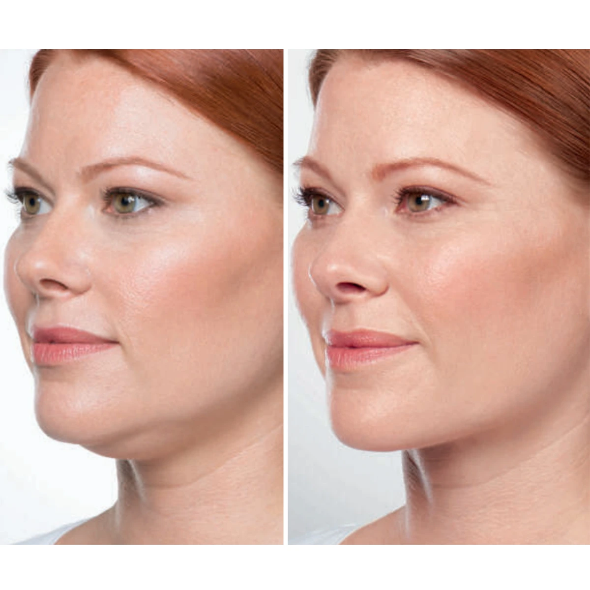 Kybella submental fullness treatment, St. Louis Dermatology & Cosmetic Surgery