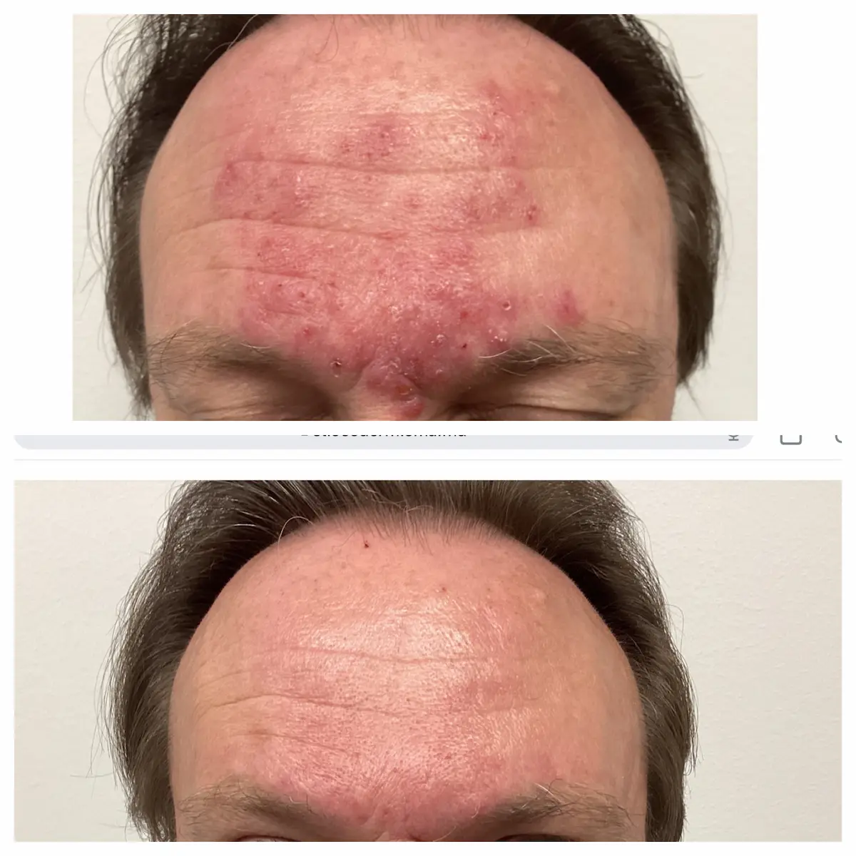 Rosacea and forehead redness before and after — St. Louis Dermatology & Cosmetic Surgery