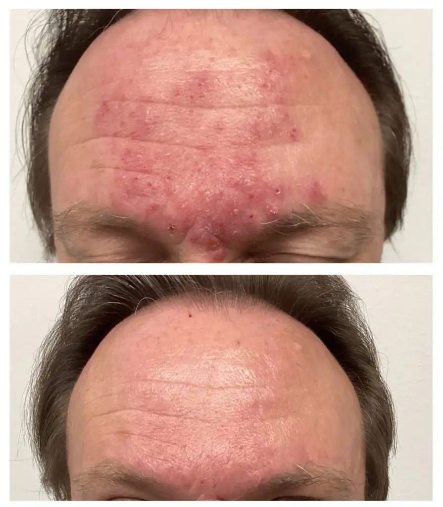 Forehead rosacea and redness before and after — St. Louis Dermatology & Cosmetic Surgery