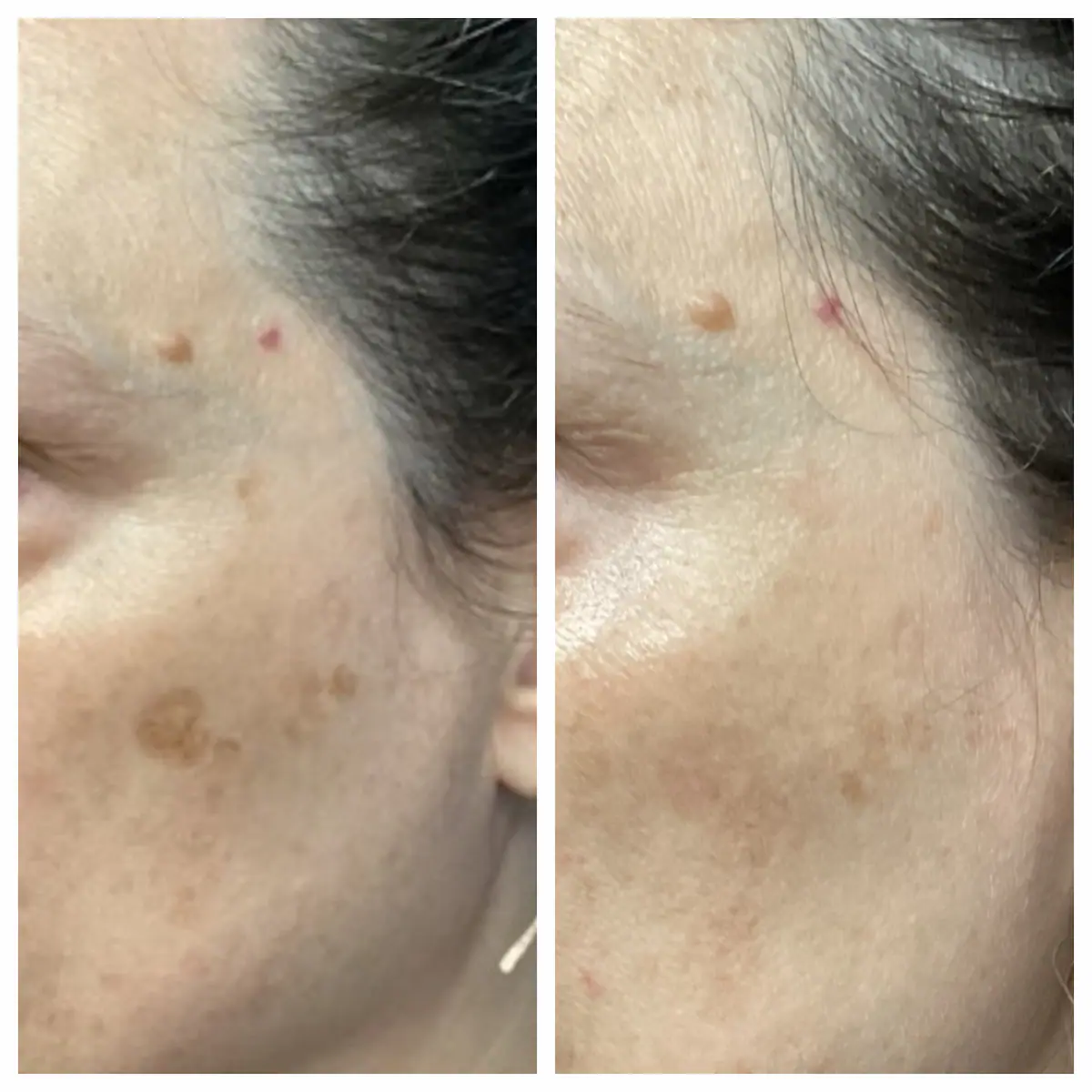 IPL brown spot treatment before and after at the temple — St. Louis Dermatology & Cosmetic Surgery