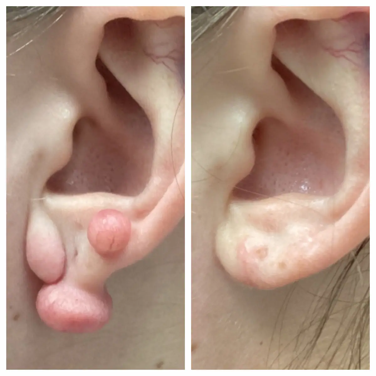 Earlobe keloid removal and repair before and after — St. Louis Dermatology & Cosmetic Surgery