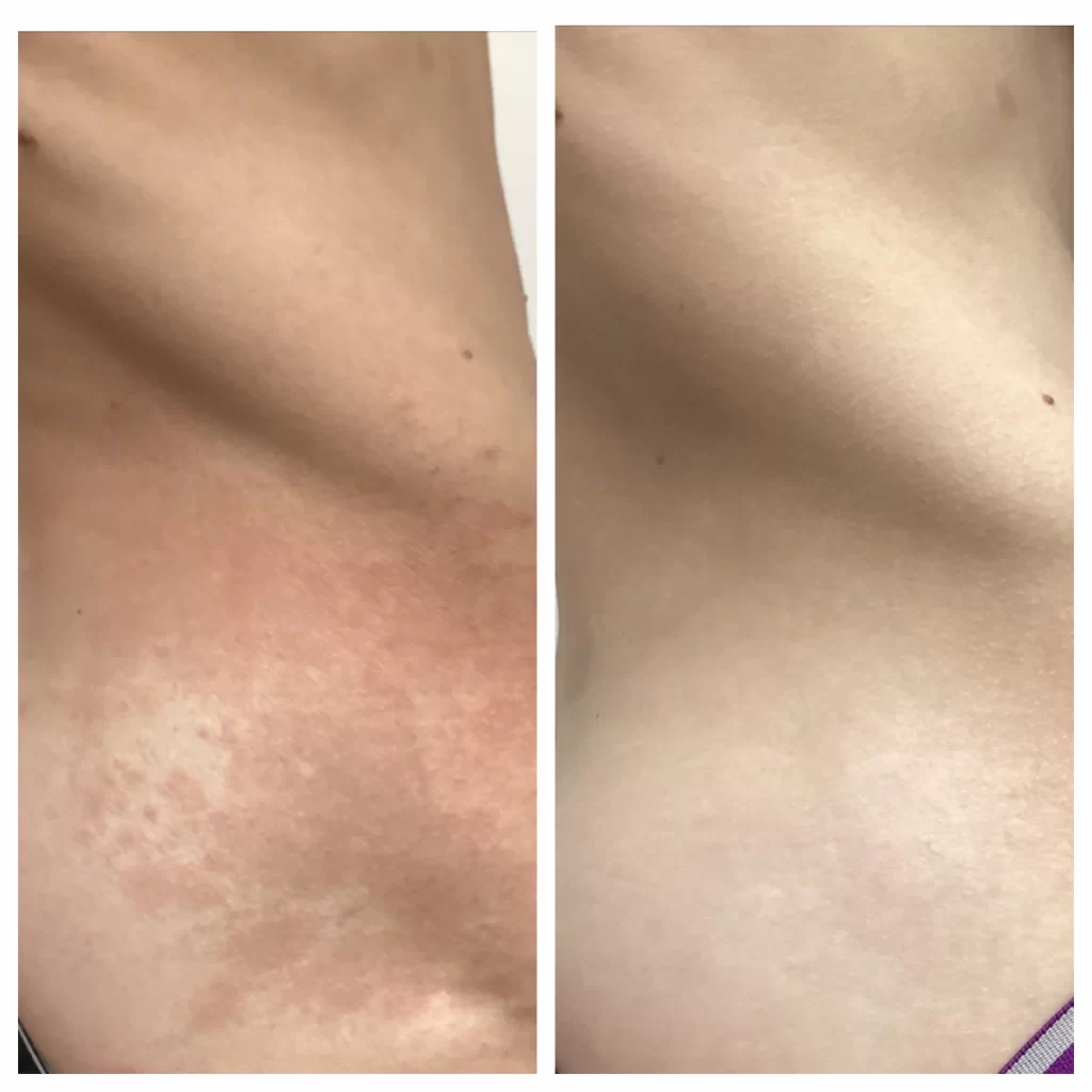 Rash before & after