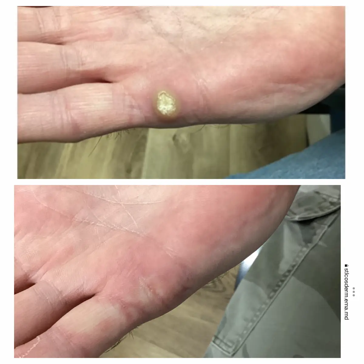 tying thread around a wart
