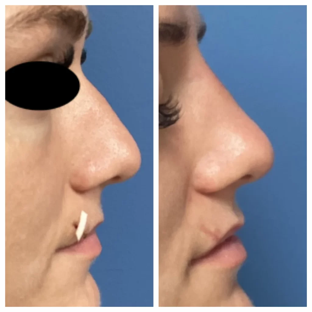 non-surgical-rhinoplasty-st-louis (1)