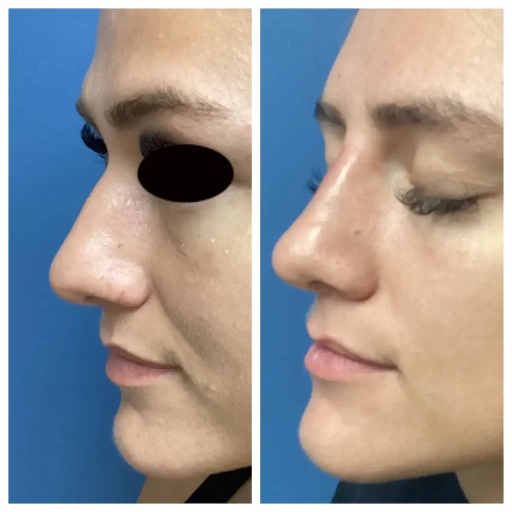 non-surgical-rhinoplasty-st-louis (3)