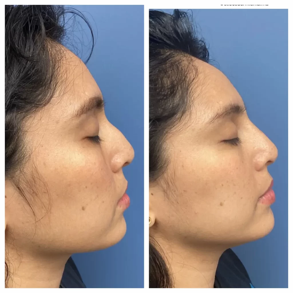 non-surgical-rhinoplasty-st-louis (5)