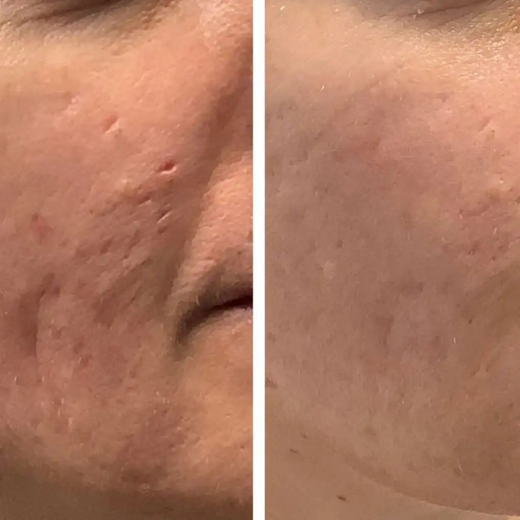 Acne Scar Treatment