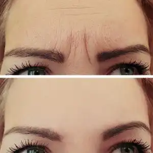 cost-of-botox
