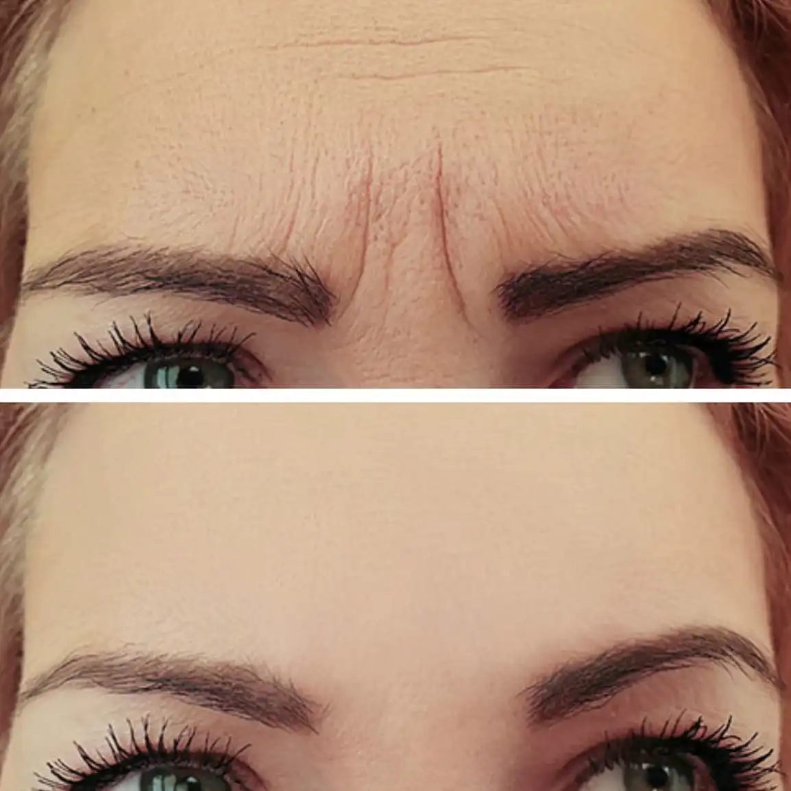 cost-of-botox
