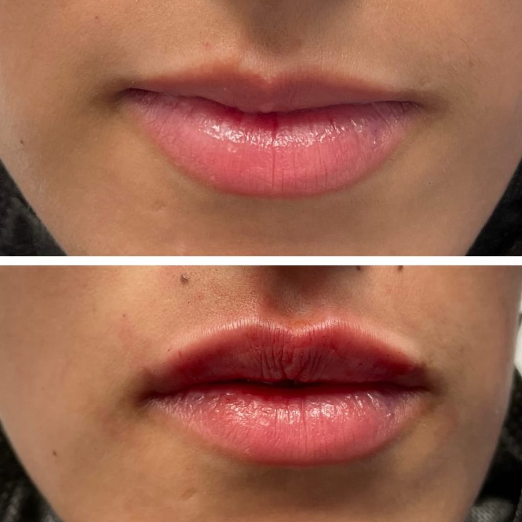 lip-filler-st-louis-1