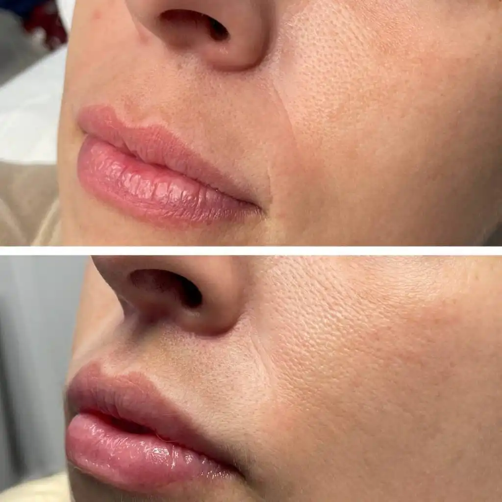 Lip lift before and after — St. Louis Dermatology & Cosmetic Surgery
