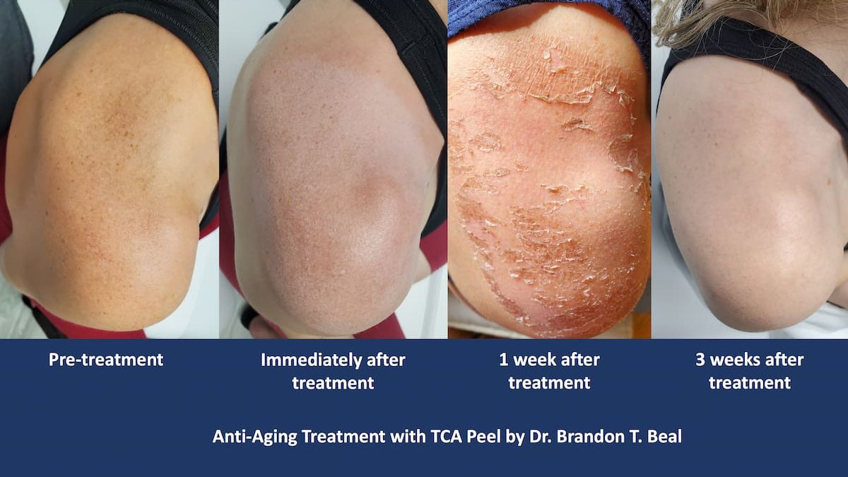 tca-peel-sun-spots-before-and-after
