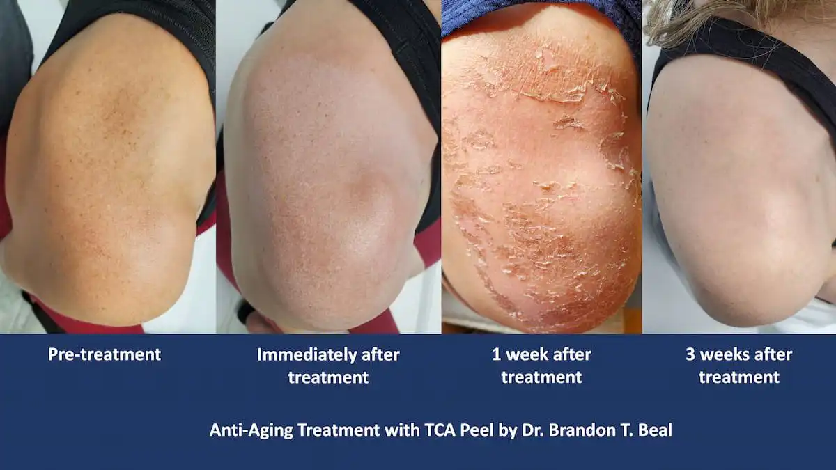 TCA chemical peel for sun spots, healing progression from pre-treatment to three weeks after — St. Louis Dermatology & Cosmetic Surgery