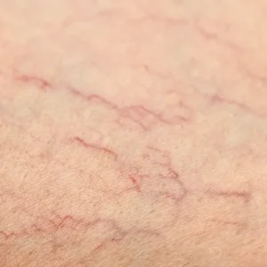 spider-vein-treatment