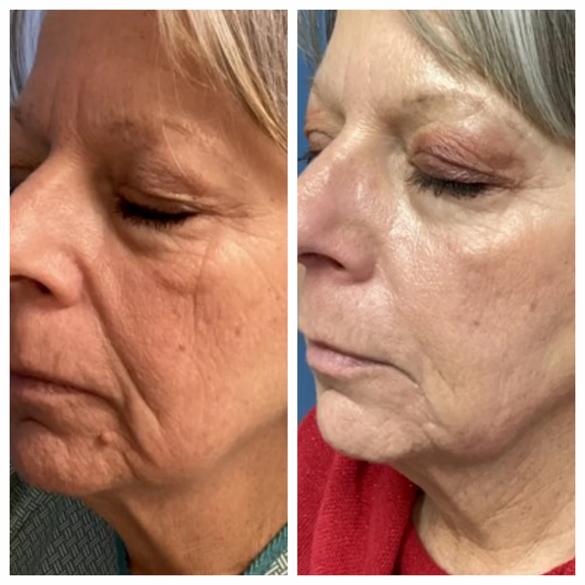 Cheek filler before and after — St. Louis Dermatology & Cosmetic Surgery