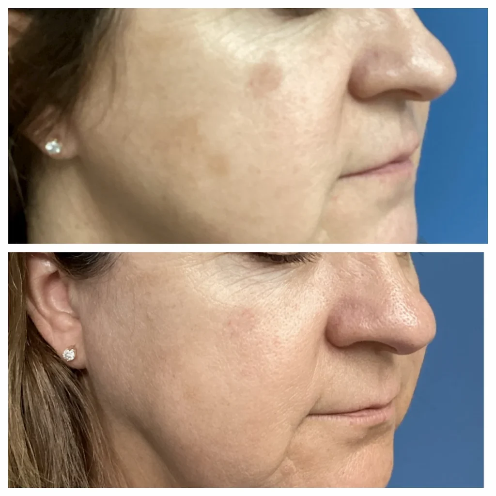 Chemical Peel before and after