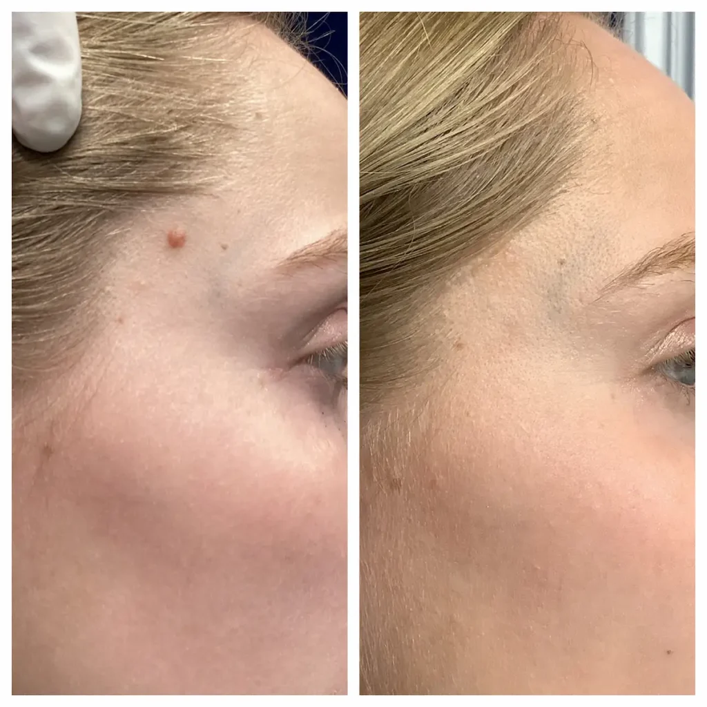 Cosmetic Mole Removal