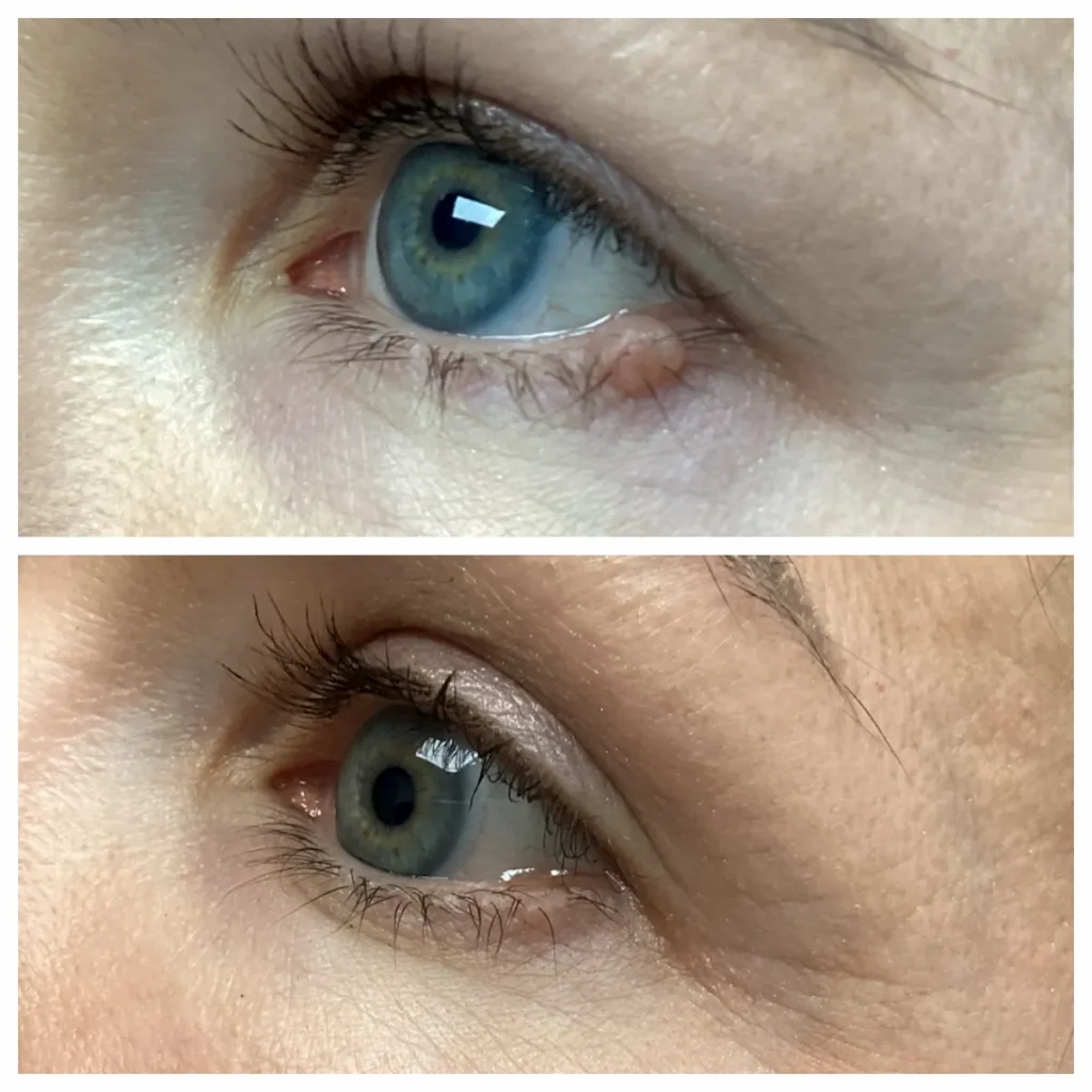 Cosmetic Mole Removal Eyelid