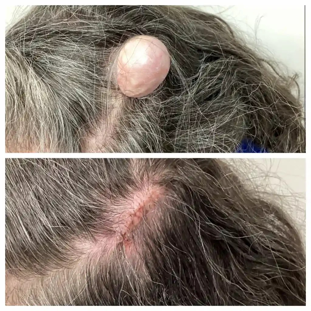 Cyst scalp before and after